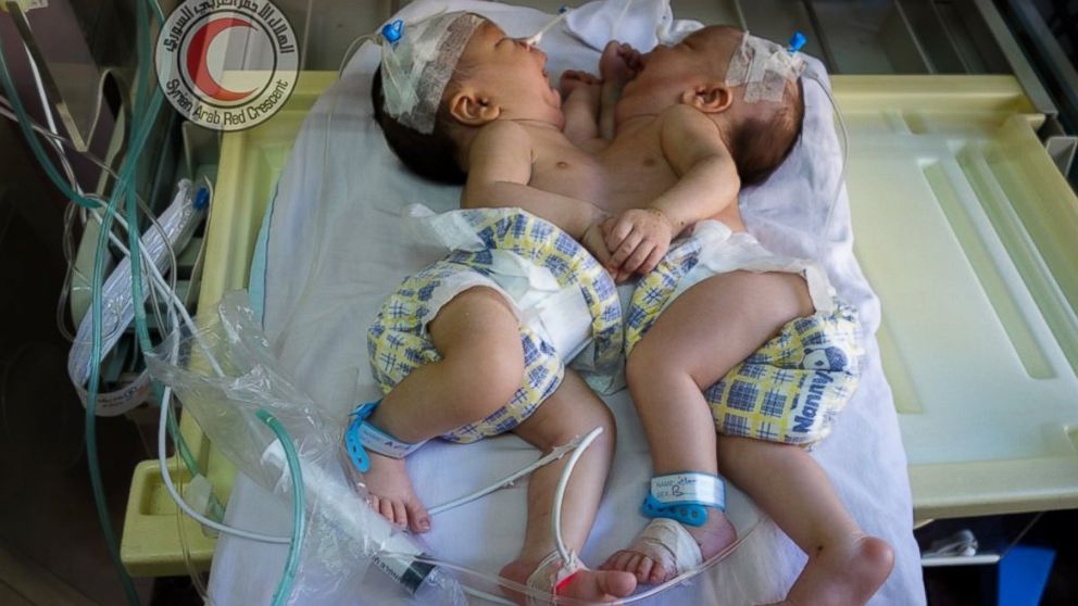 Conjoined twins who were evacuated from the Syrian town of Ghouta to a hospital in Damascus on Aug. 12, 2016 have died of heart failure, the Syrian Red Crescent announced.