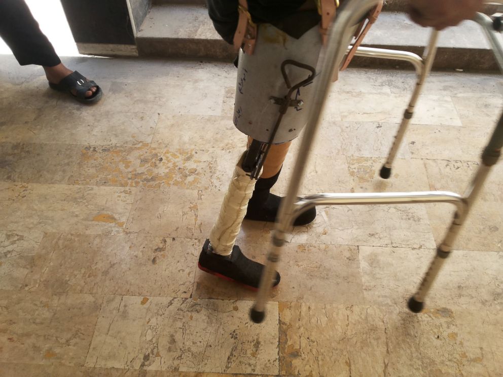 PHOTO: Handmade prosthetics like these are allowing locals to walk again. / Ahmad Khalil for Syria Deeply