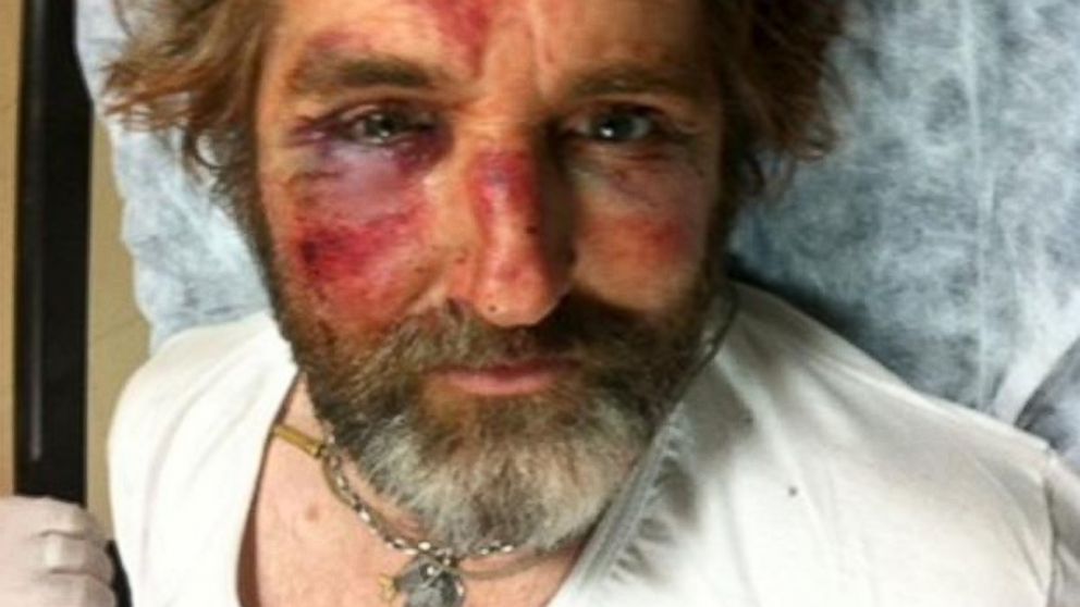 Anthony Loyd, visibly bruised, recovers in a hospital in Turkey in this undated photo provided by The Times of London.