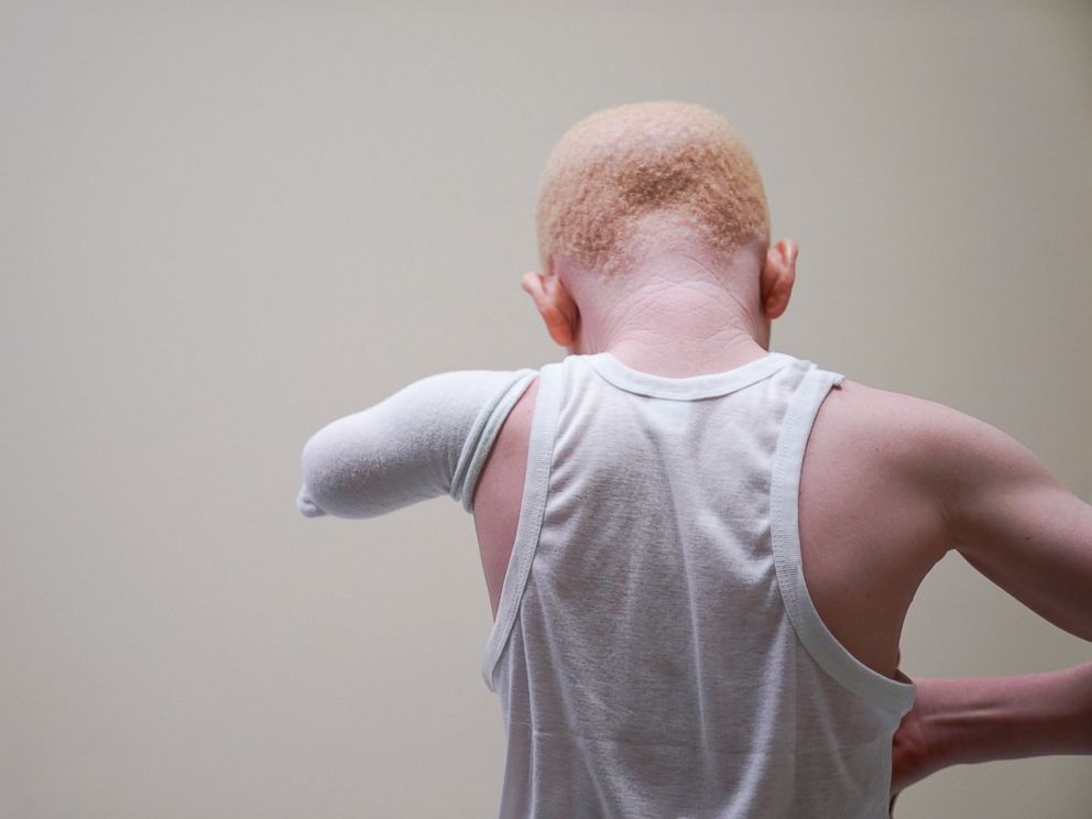 PHOTO: Mwigulu Magesaa, 14, a Tanzanian with albinism who had an arm chopped off in a witchcraft-driven attack, waits in an examination room during a prosthetic fitting at the Shriners Hospital in Philadelphia, May 30, 2017.