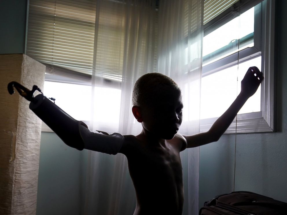 PHOTO: Baraka Lusambo, 7, a Tanzanian with albinism who had an arm chopped off in a witchcraft-driven attack, puts on his prosthetic arm at the Global Medical Relief Fund house in the Staten Island borough of New York, June 3, 2017.