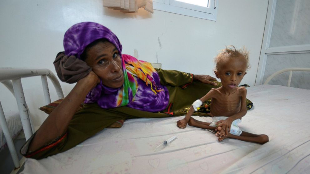 PHOTO: A woman rests on a bed next to her malnourished son at a hospital in the Red Sea port city of Houdieda, Yemen, Sept. 9, 2016.