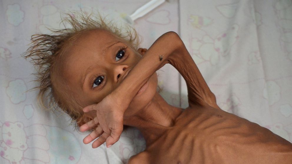 PHOTO: A malnourished boy lies on a bed at a hospital in the Red Sea port city of Houdieda, Yemen, Sept. 9, 2016. 