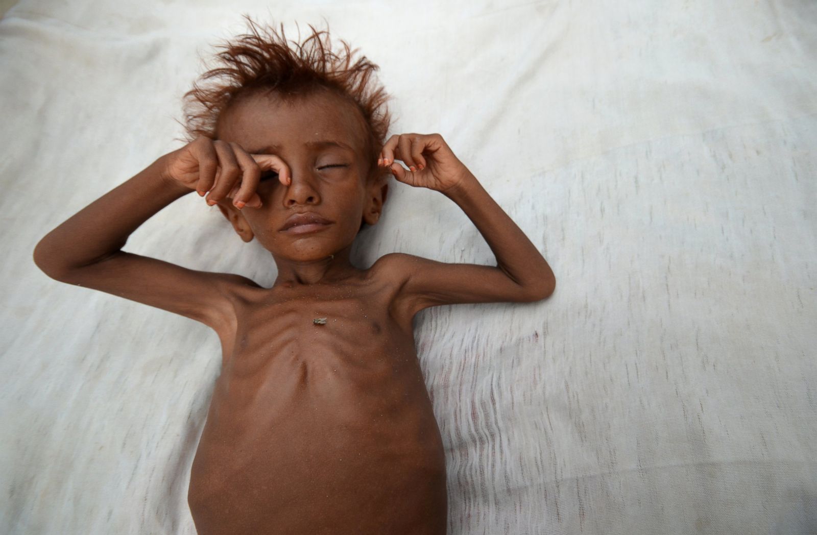 Famine Threatens Yemen Amid Civil War Photos | Image #71 - ABC News