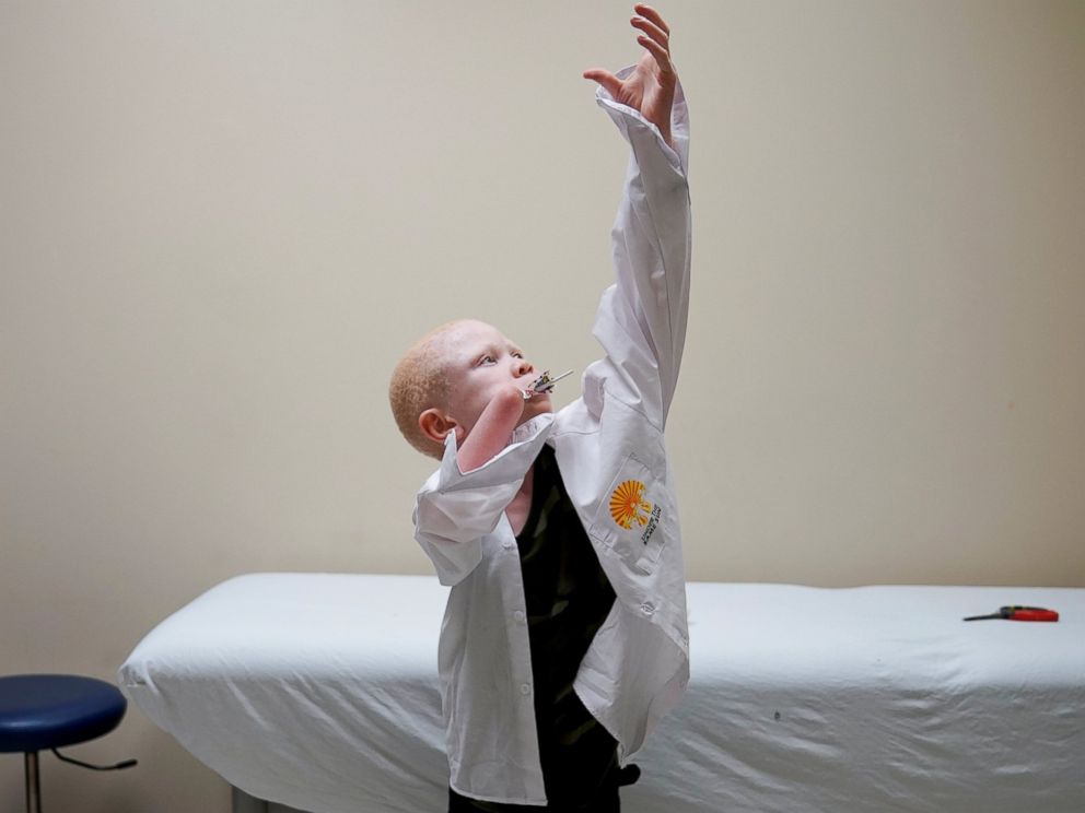 PHOTO: Baraka Lusambo, 7, a Tanzanian with albinism who had an arm chopped off in a witchcraft-driven attack, puts on his shirt during a prosthetic fitting while he sucks on his lollipop, at the Shriners Hospital in Philadelphia, May 30, 2017.
