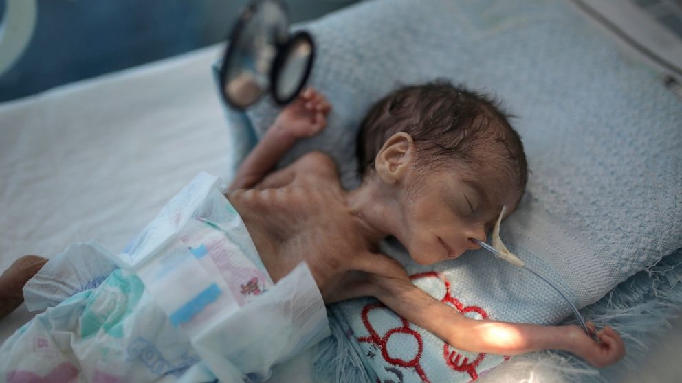 FILE - In this Nov. 23, 2019 file photo, a malnourished newborn baby lies in an incubator at Al-Sabeen hospital in Sanaa, Yemen. The United Nations Children’s Fund on Monday, Dec. 7, 2020, launched a global appeal for a record $2.5 billion of emergen