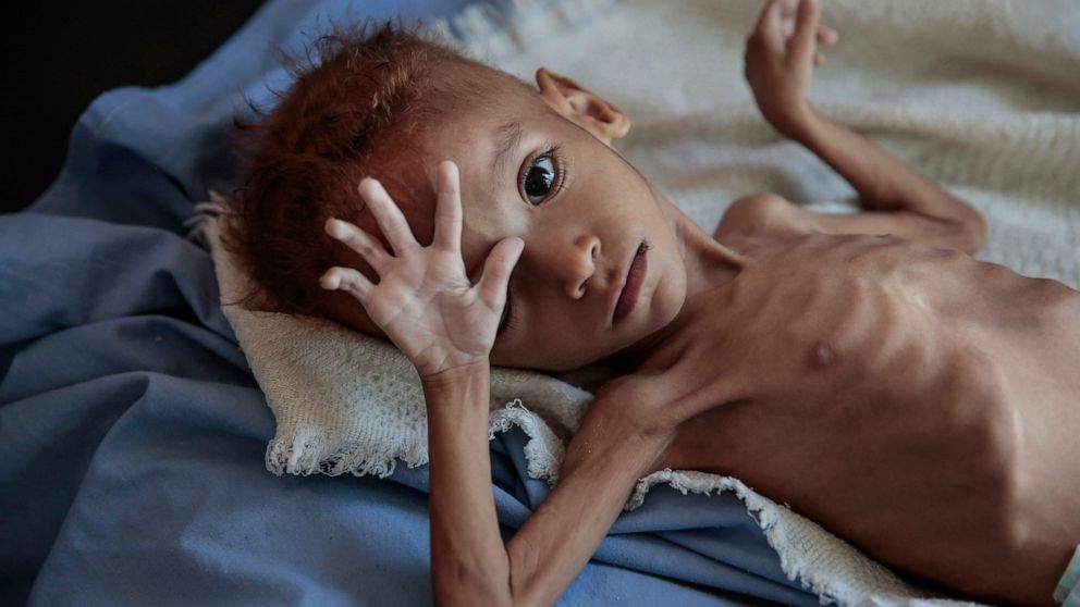 Groups: Both sides used starvation as tool in Yemen war