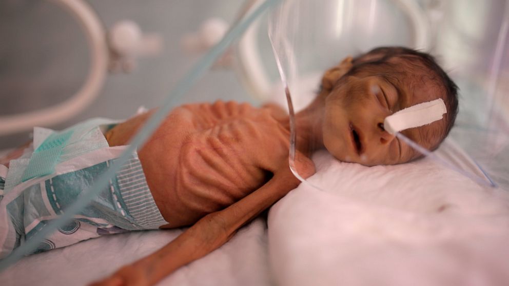 UN food agency says 13 million Yemenis may face starvation