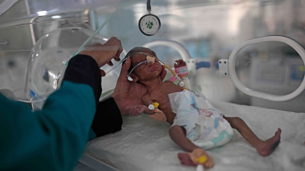 FILE - In this June 27, 2020 file photo, a medic checks a malnourished newborn baby inside an incubator at Al-Sabeen hospital in Sanaa, Yemen. Human Rights Watch warned Monday, Sept. 14, 2020 that warring parties in Yemen's yearslong conflict are “se
