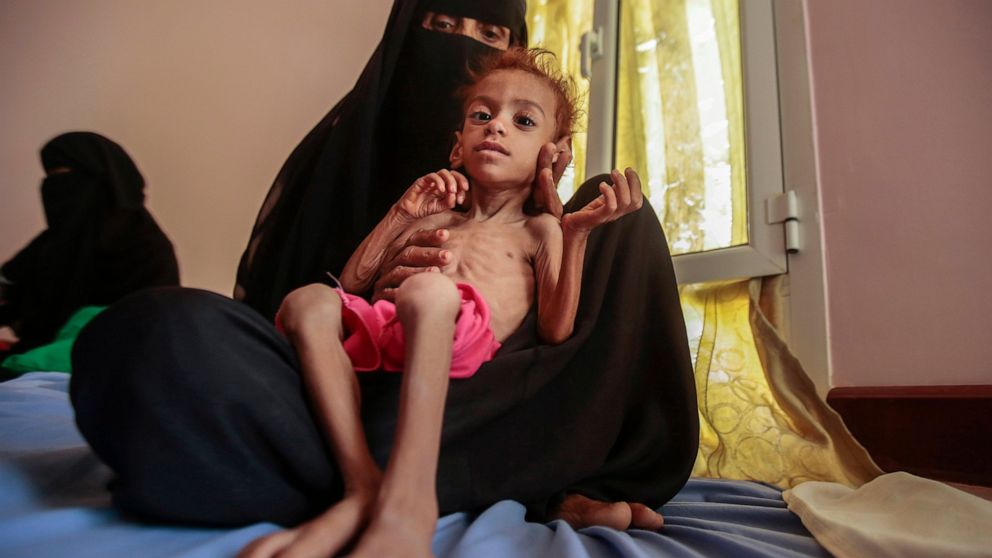 FILE - In this Oct. 1, 2018, file photo, a woman holds a malnourished boy at the Aslam Health Center, in Hajjah, Yemen. A leading aid organization on Monday warned that U.S. Secretary of State Mike Pompeo's move to designate Yemen’s Iran-backed Houth