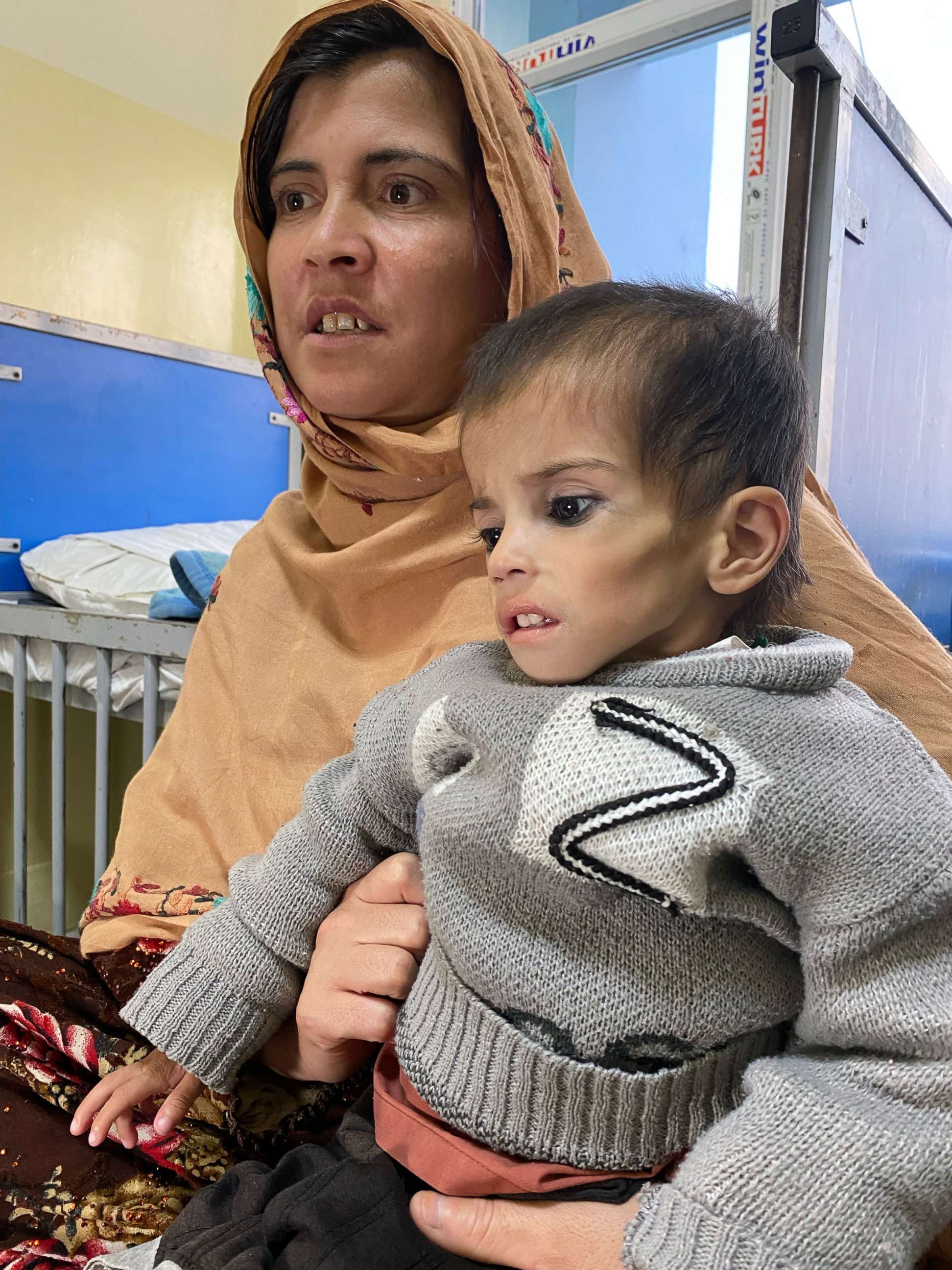 PHOTO: Two-year-old Mohammed weighs just 11 lbs.