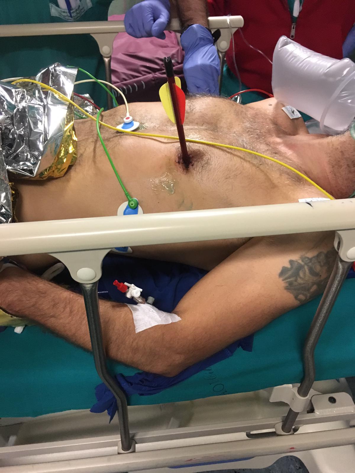PHOTO: An Italian man survived surgery in a Turin, Italy hospital to remove an arrow in his chest that had punctured his heart and lung.