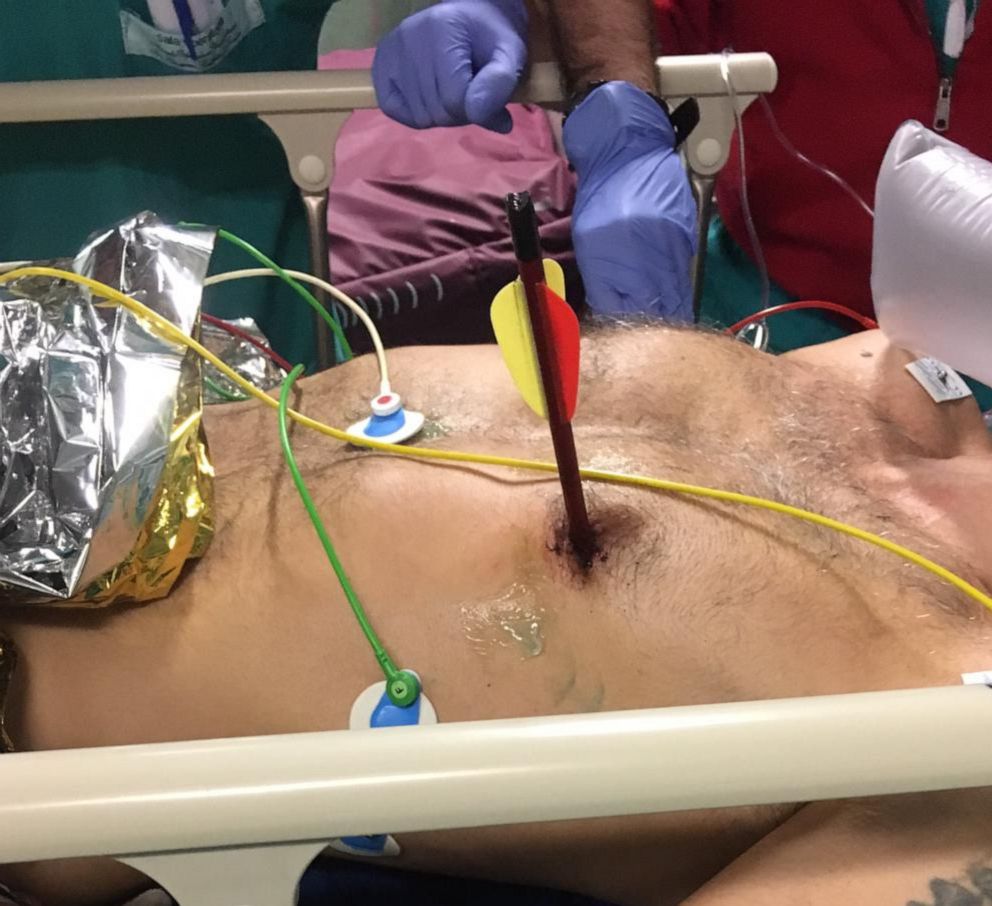 PHOTO: An Italian man survived surgery in a Turin, Italy hospital to remove an arrow in his chest that had punctured his heart and lung.
