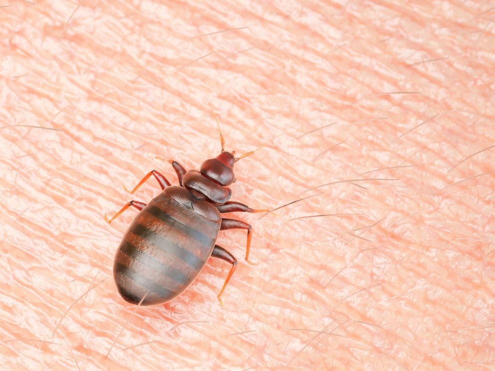 PHOTO: An Illustration of a bedbug on human skin is seen in an undated stock photo.