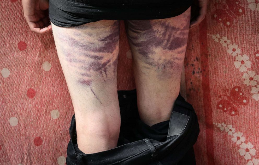 PHOTO: Bruises on the legs of a man, who was reportedly beaten by the police, after being released from a detention center in Minsk, Belarus, Aug. 14, 2020.