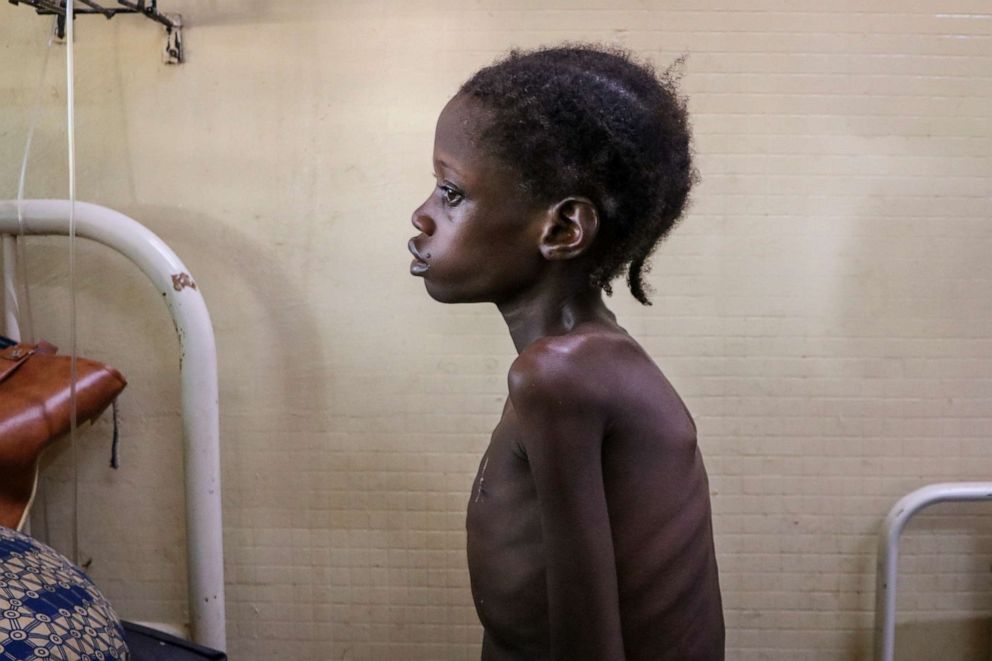 PHOTO: Nafissetou Niampa, 14, who struggles to breathe due to a heart condition, is treated for malnutrition at Yalgado Ouedraogo University in Ouagadougou, Burkina Faso, June 22, 2020.