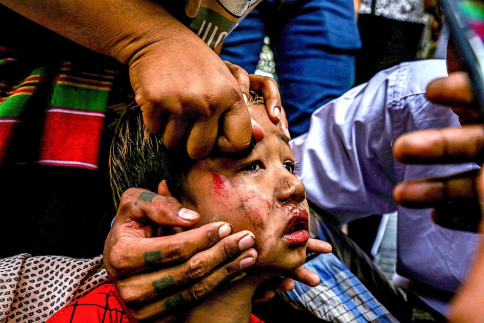 PHOTO: Adults tend to a bruised child who was hit by a slingshot fired by soldiers  during an anti-coup demonstration in Mandalay, Myanmar, Feb. 2, 2021. People sustained injuries when Myanmar security forces shot at anti-military coup protesters.