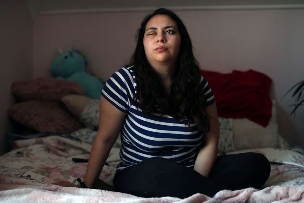 PHOTO: Natalia Aravena, who lost an eye after a riot police officer's tear gas canister exploded into her face, poses for a photograph inside her bedroom in Santiago, Chile, Nov. 6, 2019.