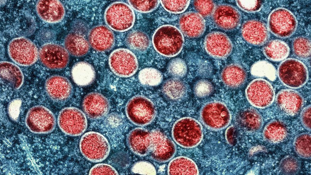 PHOTO: A colorized transmission electron micrograph shows monkeypox particles (red) found within an infected cell (blue), cultured in the laboratory that was captured and color-enhanced at the NIAID Integrated Research Facility in Fort Detrick, Md.