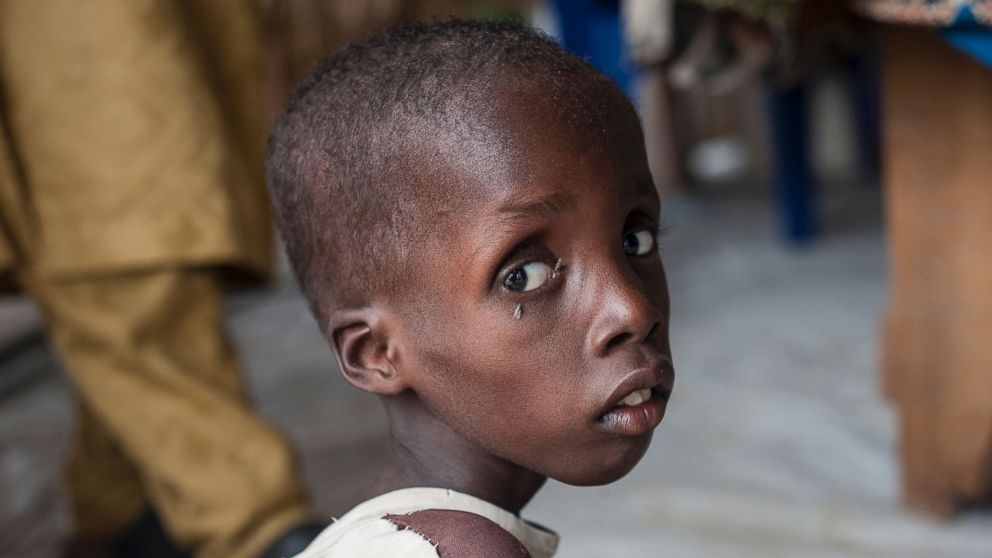 A boy suffering from severe acute malnutrition sitting at one of the Unicef nutrition clinics, in the Muna informal settlement, which houses nearly 16,000 IDPs (internally displaced people) in the outskirts of Maiduguri capital of Borno State, northeastern Nigeria, June 30, 2016. 