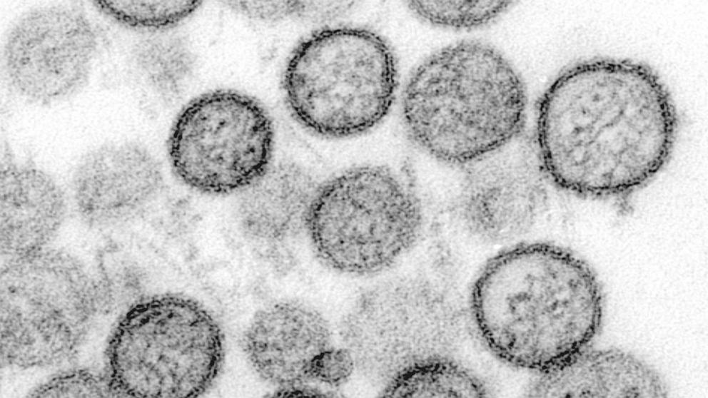 PHOTO: A transmission electron micrograph of Hantavirus is shown.