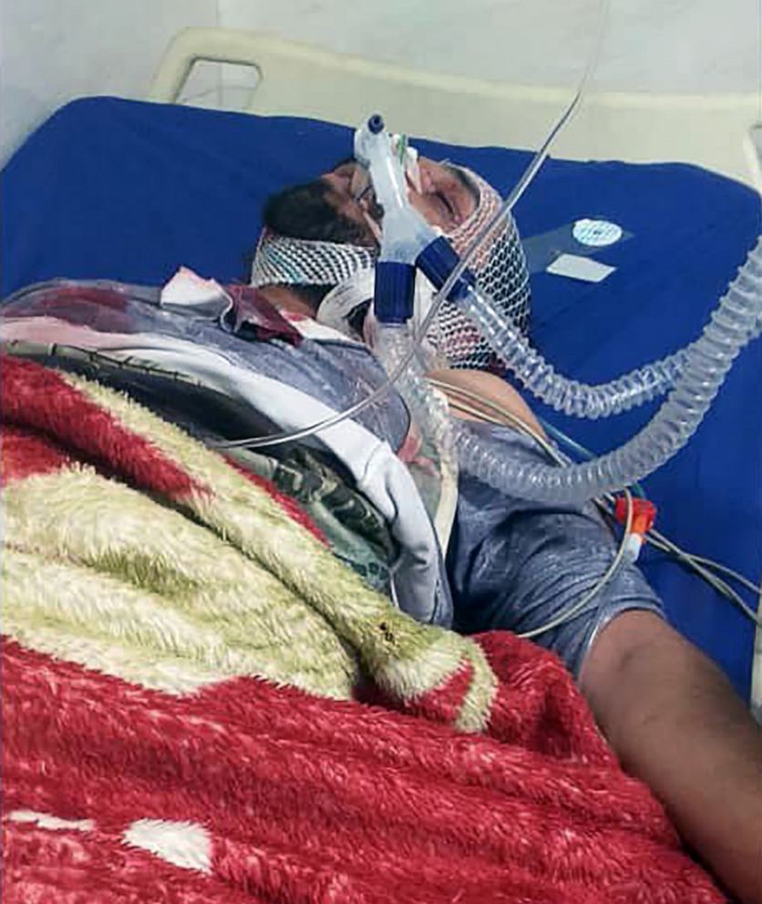 PHOTO: Mahyar Ebrahimi was shot in the face during protests in Iran in November, 2019, and says he spent eight days in intensive care.