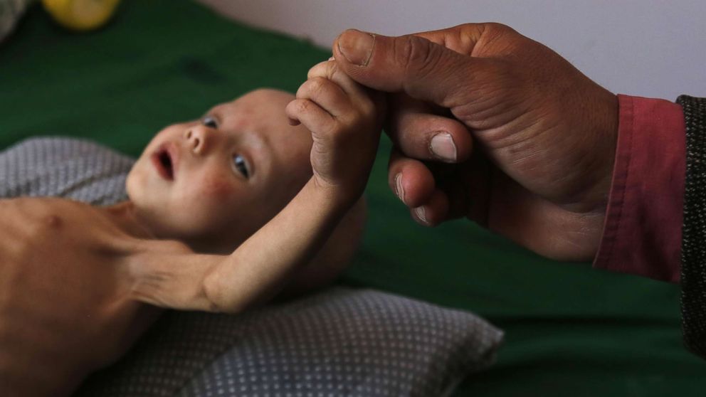 PHOTO:A malnourished Yemeni child receives treatment amid worsening malnutrition in the emergency ward of a hospital in Sana'a, Yemen,Nov. 15, 2017. More than 50,000 children under the age of 15 are at risk of death from severe acute malnutrition. 