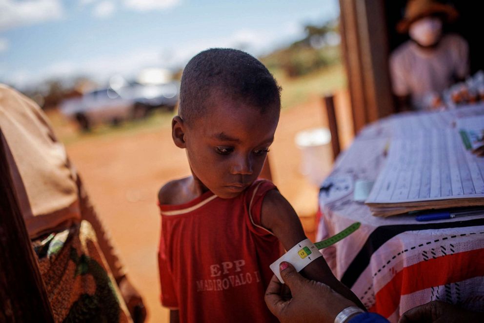 PHOTO: Avoraza, 4, is examined at a children's malnutrition post run by the World Food Programme in Anjeky Beanatara, Madagascar, Feb. 11, 2022.