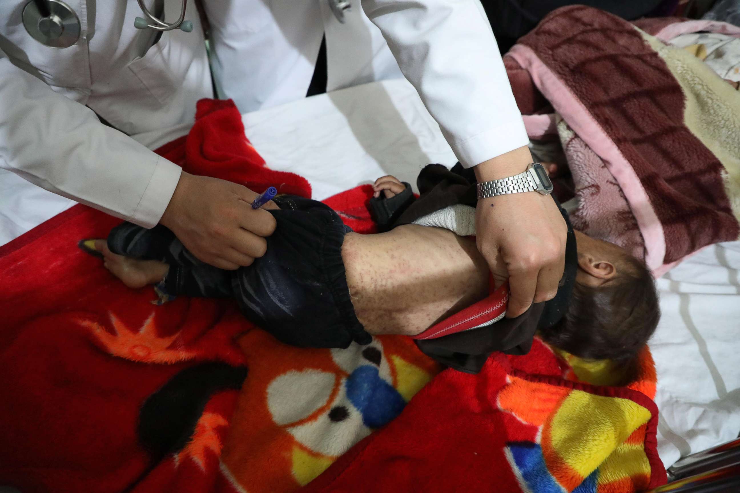 PHOTO: A child is examined by medical staff, in capital Kabul, Afghanistan, April 18, 2022.