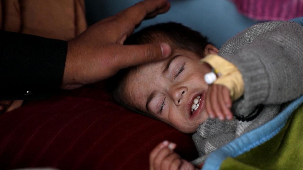 PHOTO: Suffering from malnutrition, 2-year-old Mohammed Alikhil lies in bed, with no strength to open his eyes.