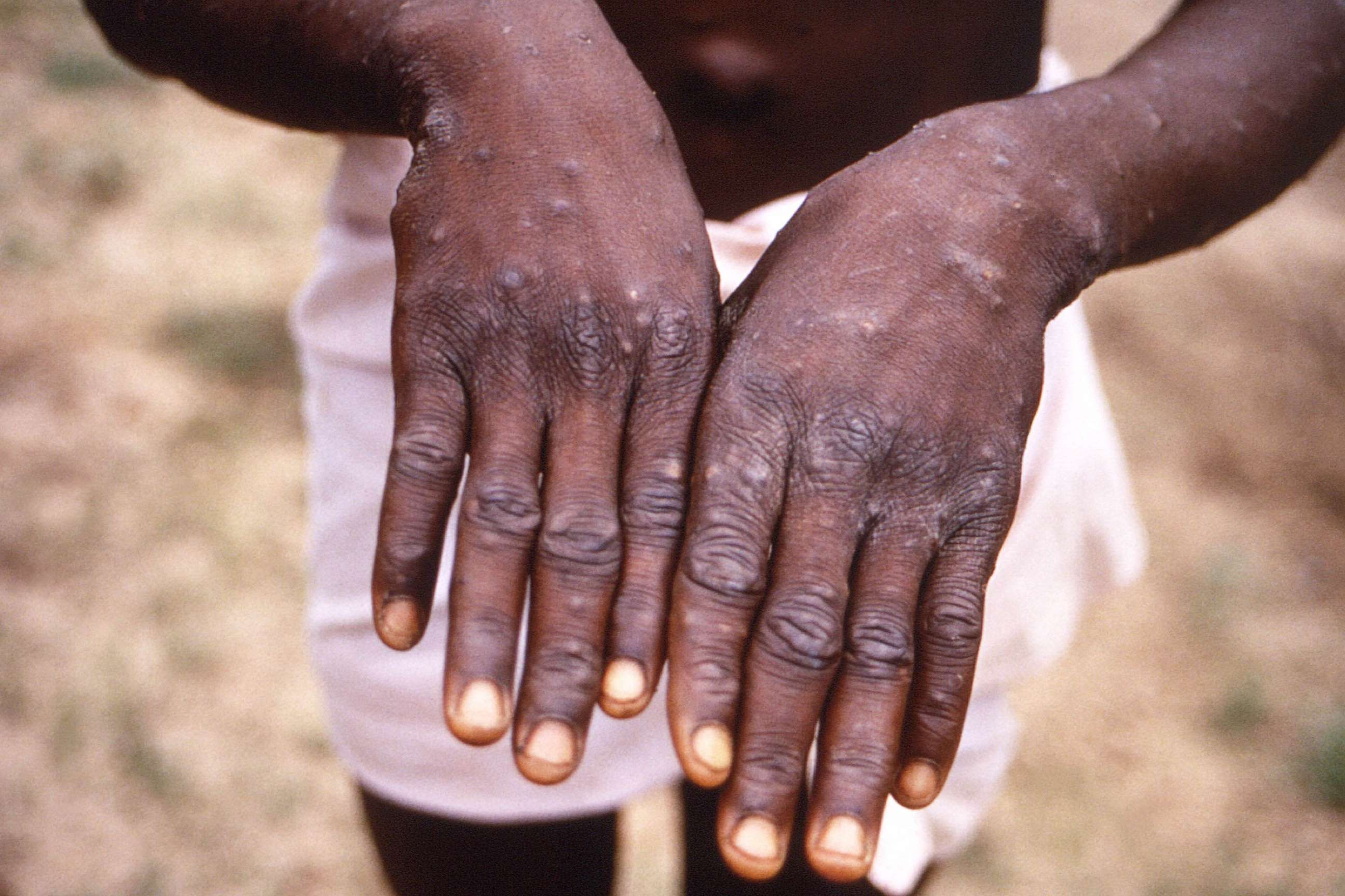 PHOTO: A rash due to monkeypox marks the hands of a patient during an investigation into an outbreak in the Democratic Republic of Congo during 1996 to 1997.