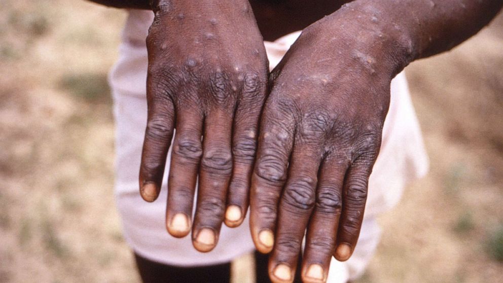 PHOTO: A rash due to monkeypox marks the hands of a patient during an investigation into an outbreak in the Democratic Republic of Congo during 1996 to 1997.