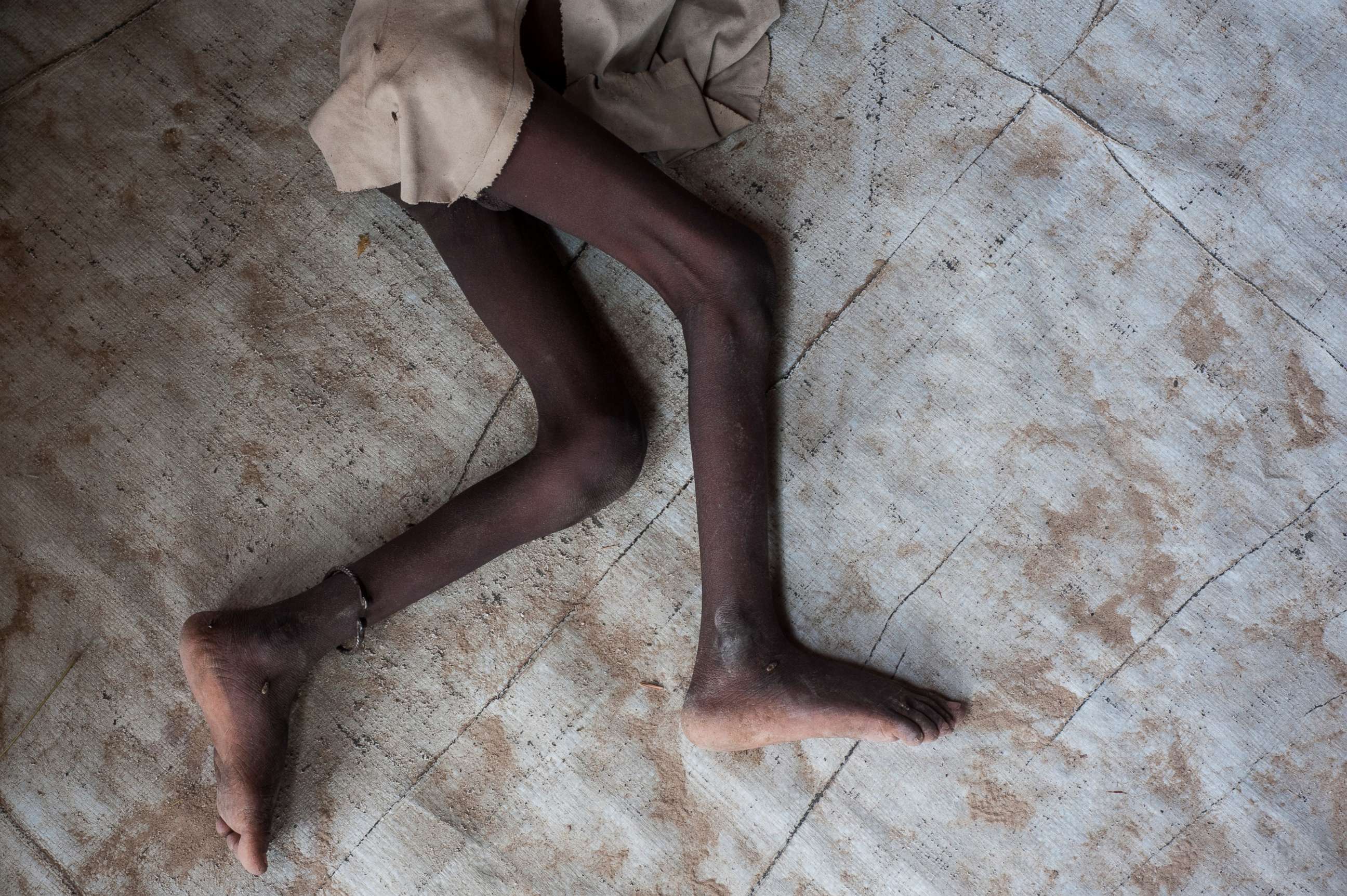 PHOTO: A young boy suffering from severe acute malnutrition lies in the Muna informal settlement, which houses nearly 16,000 IDPs (internally displaced people), in the outskirts of Maiduguri capital of Borno State, northeastern Nigeria, June 30, 2016. 