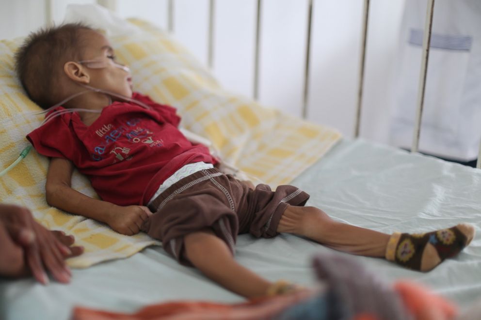PHOTO: At a hospital in Cucuta, Colombia, Ofreiber, not even two years old, shows the signs of malnutrition many Venezuelan children suffer in their country. 