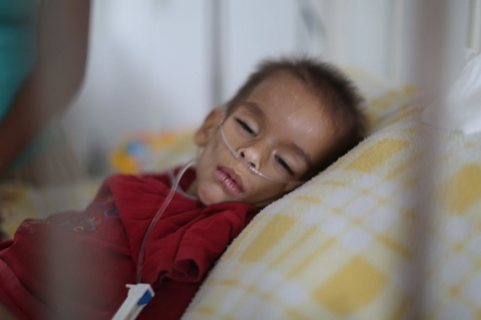 PHOTO: At a hospital in Cucuta, Colombia, Ofreiber, not even two years old, shows the signs of malnutrition many Venezuelan children suffer in their country. He is not able to open his eyes, move or talk.