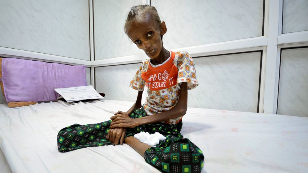 Saida Ahmad Baghili, 18, suffering from severe acute malnutrition, sits on a bed at the al-Thawra hospital in the Red Sea port city of Houdieda, Yemen, Oct. 24, 2016.