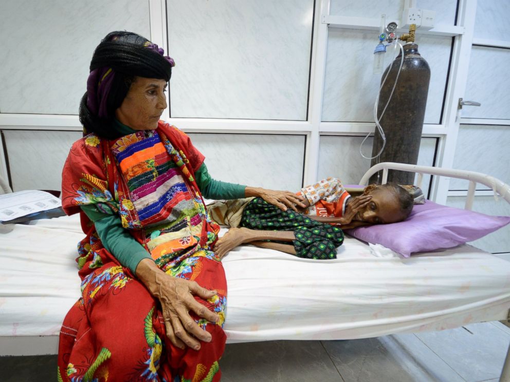 PHOTO: A relative of Saida Ahmad Baghili sits next to her at the al-Thawra hospital where she receives treatment for severe acute malnutrition in the Red Sea port city of Houdieda, Yemen, Oct. 24, 2016.