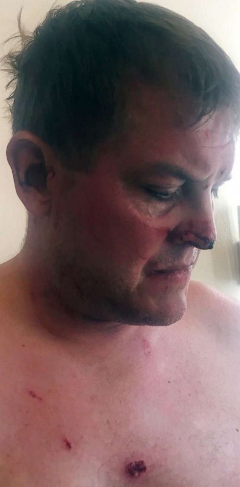 PHOTO: Scott Hapgood shows injuries his family says he sustained trying to protect him his family during an attack at a hotel in Anguilla.
