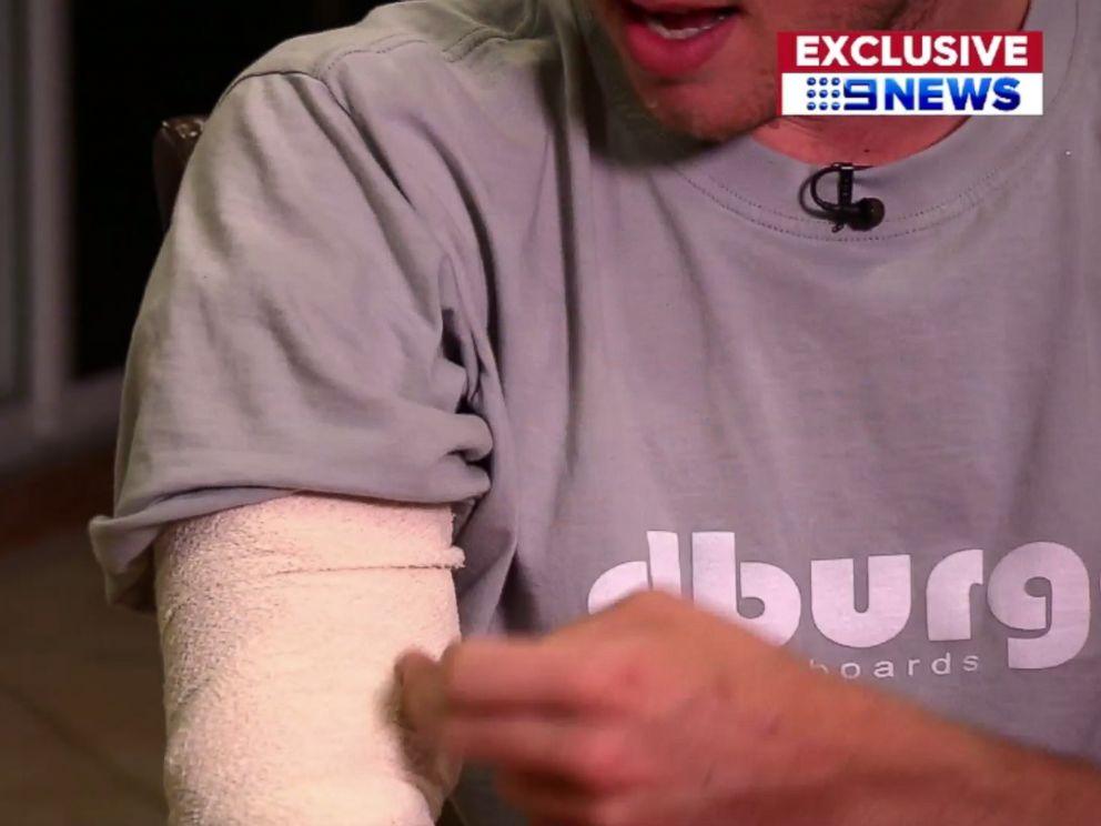 PHOTO: Charlie Fry, 25, is interviewed about being attacked by a shark at Avoca Beach, Australia, Nov. 14, 2017.