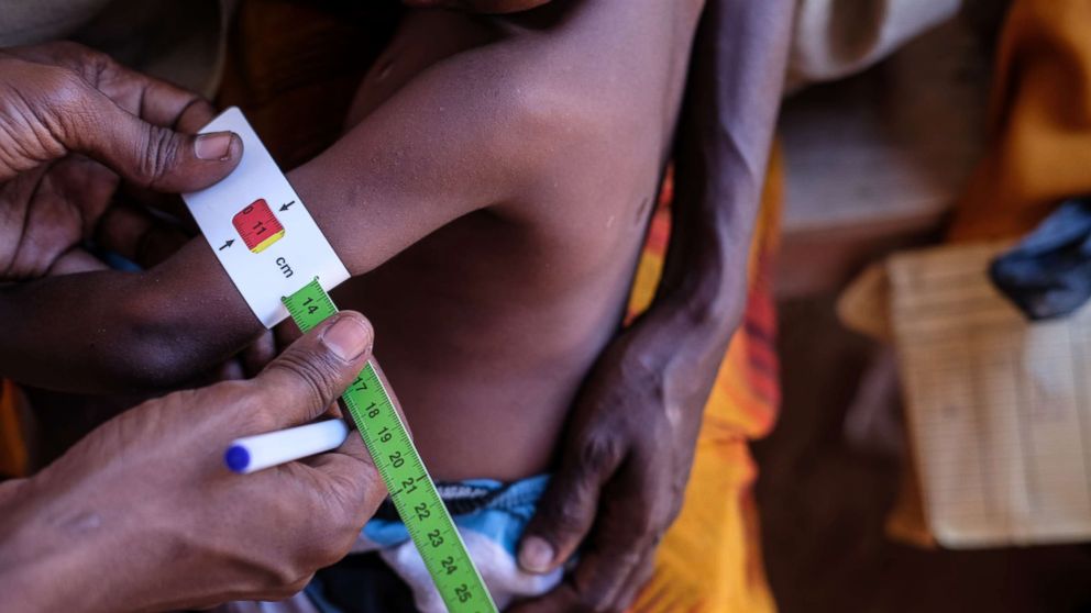 PHOTO: A doctor measures the arm of a malnourished girl. Drought has caused crops to fail and cattle to die in Somalia causing severe food and water shortages. 