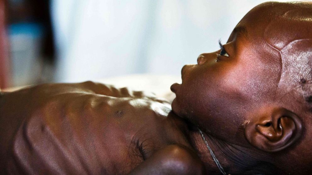 PHOTO: Agop Manut, 11-months-old, who suffers from acute malnutrition and respiratory distress, is assisted at the clinic run by Doctors without Borders (MSF) in Aweil, Northern Bahr al Ghazal, South Sudan, Oct. 11, 2016.