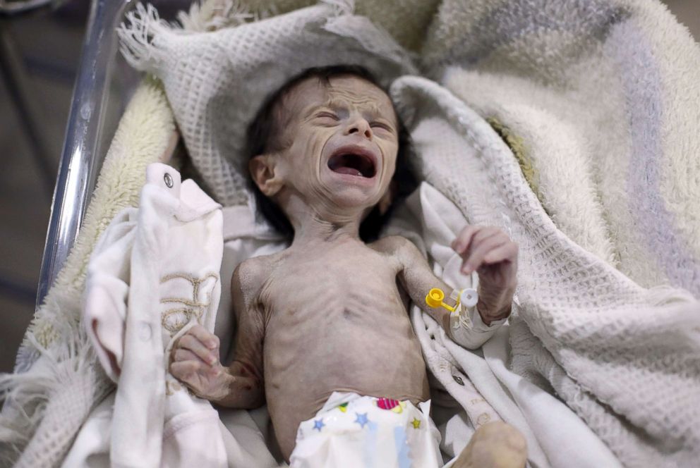 PHOTO: A Syrian infant suffering from severe malnutrition is seen at a clinic in the rebel-controlled town of Hamouria, in the eastern Ghouta region, Oct. 21, 2017.