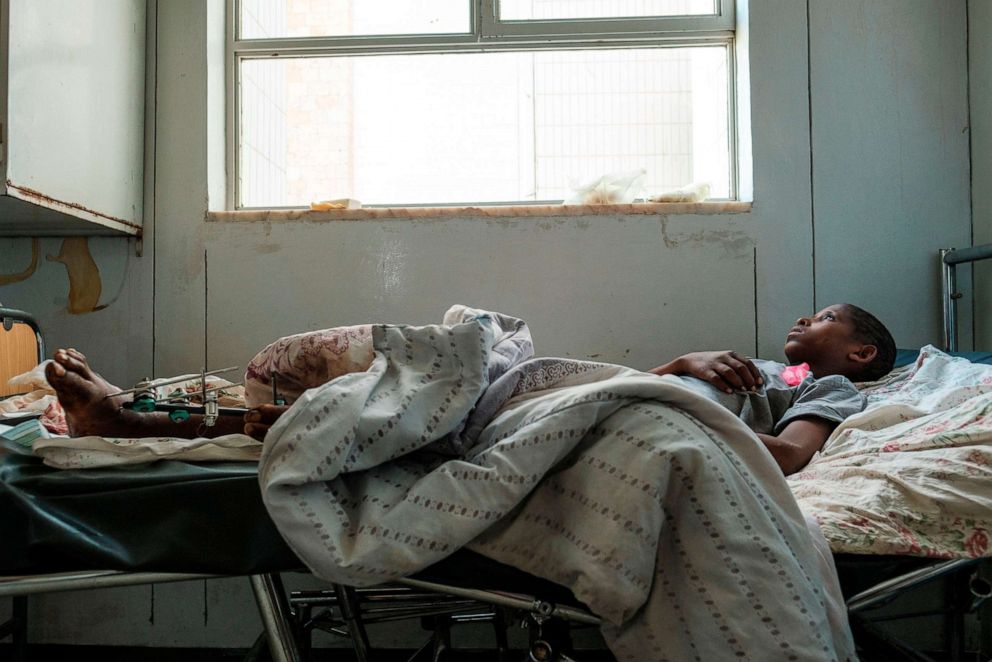 PHOTO: Desalegn Gebreselassie, 15,  lies in his bed at Ayder Referral Hospital in the Tigray capital Mekele on Feb. 25, 2021, after being injured during fighting between the Tigray People's Liberation Front (TPLF) Ethiopian troops.