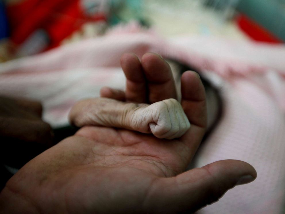 PHOTO: Saleh Hassan al-Faqeh holds the hand of his four-month-old daughter, Hajar, who died of malnutrition at the al-Sabeen hospital in Sanaa, Yemen, Nov. 15, 2018. She was like skin on bones, her body was emaciated, he said.