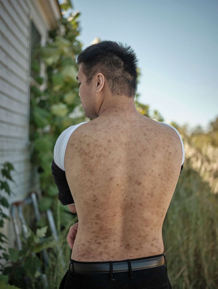 PHOTO: Andy Huynhs, one of the Americans who were released earlier this month in the massive Russian-Ukraine prisoner swap, shows off some of the wounds yet to heal in Trinity, Ala., Sept. 29, 2022.