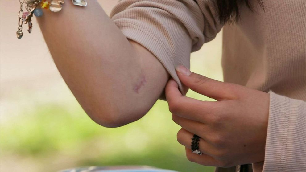 PHOTO: Dasha Pivtoratska points to the scar left by the surgery to remove a bullet.