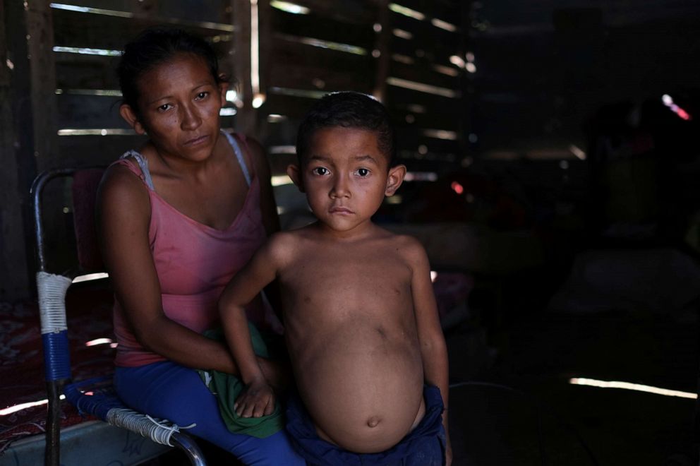 PHOTO: Rosa Rojas and her son Jose Maria, 6, who according to her is underweight for his age and has been diagnosed with malnutrition, pose for a picture at their house in Barquisimeto, Venezuela, Aug. 8, 2019.