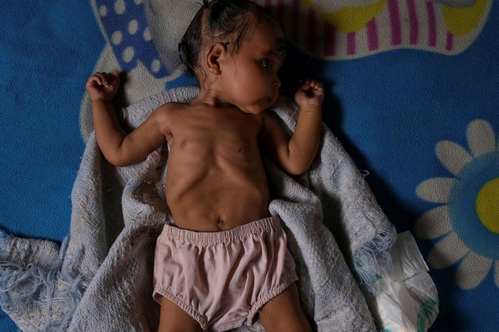 PHOTO: Sonia, seven moths old, who has diarrhoea and is underweight according to her mother, rests on a bed after bathing at her house in Barquisimeto, Venezuela, Aug. 16, 2019.