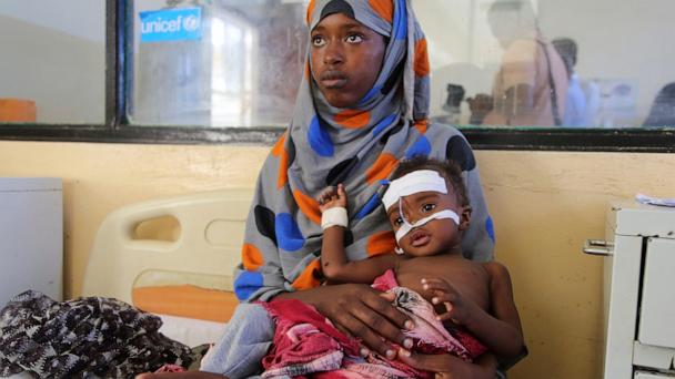 A Somali woman cares for her baby at Banadir Hospital in Mogadishu, Somalia, Wednesday, May 14, 2025. (AP Photo/Farah Abdi Warsameh)