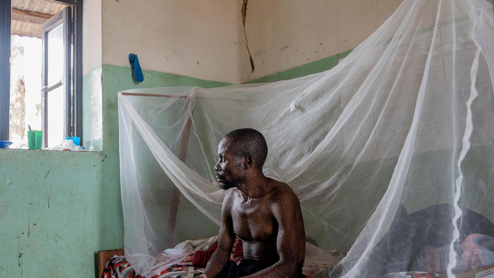 Mpox deaths rise by 107 in a week as Africa CDC calls the toll unacceptable